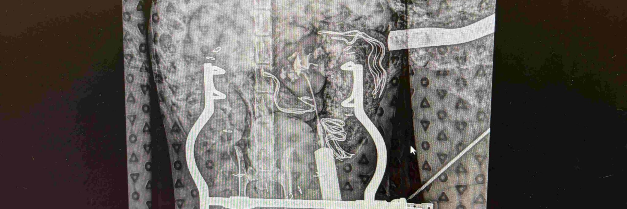 SUB Device for Cats with Ureteral Obstruction